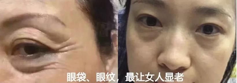去眼袋手术