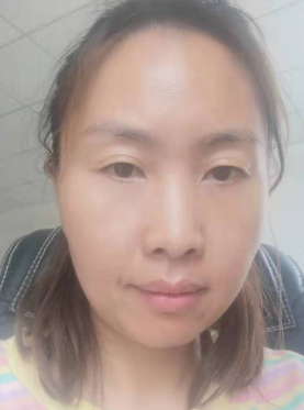 去眼袋手术