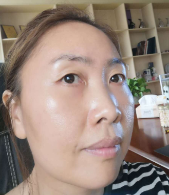 去眼袋手术