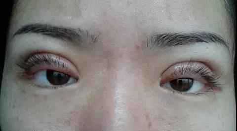 双眼皮手术