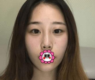 双眼皮手术
