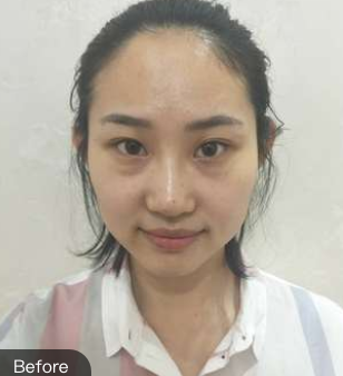 去眼袋手术
