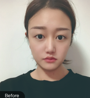 双眼皮手术