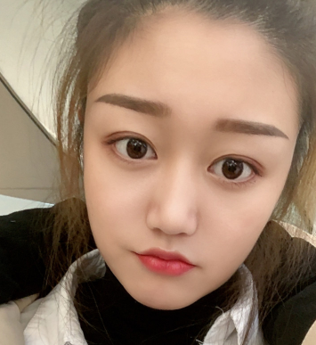 双眼皮手术