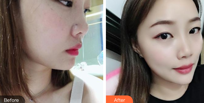 长效玻尿酸