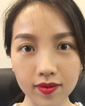 去眼袋手术