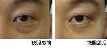 去眼袋手术