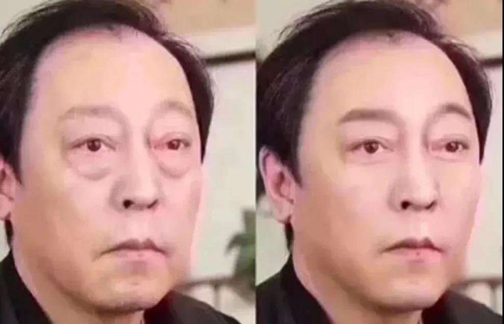 去眼袋手术