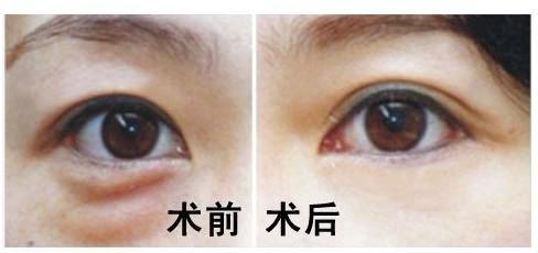 去眼袋手术