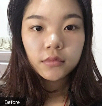 双眼皮手术