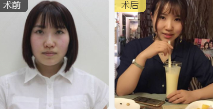 面部提升术