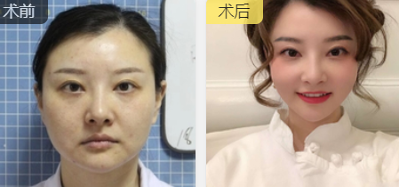 面部提升术