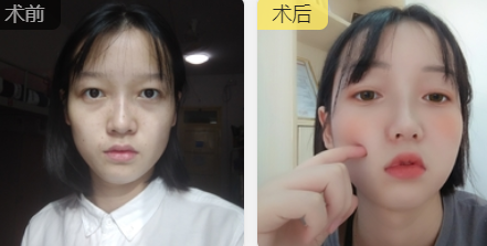 面部提升术