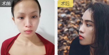 面部提升术