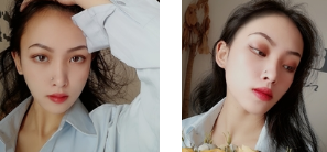 面部提升术