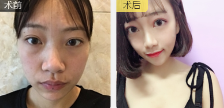 皮秒祛斑