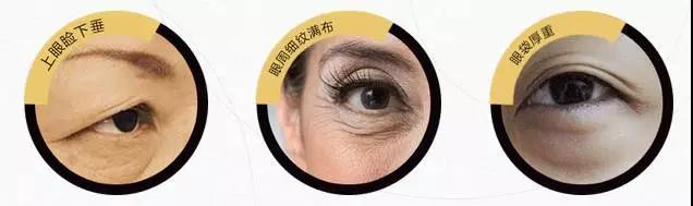 面部提升术