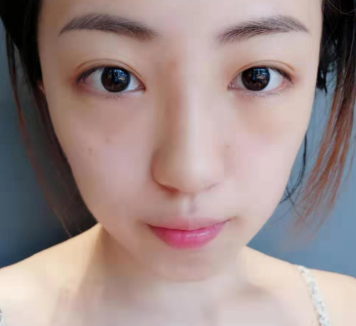 去眼袋手术