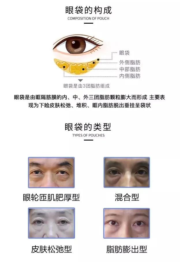 去眼袋手术