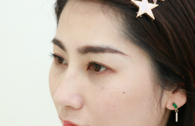 去眼袋手术