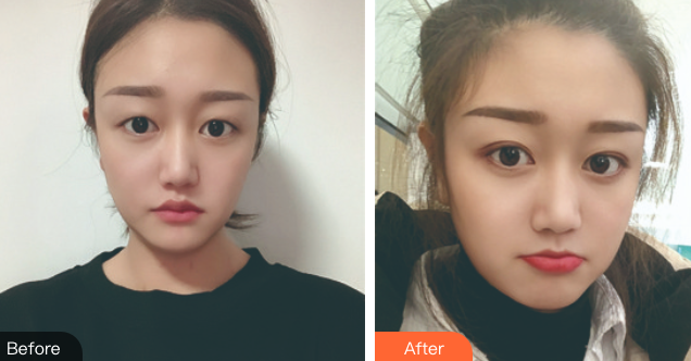双眼皮手术