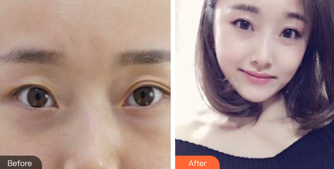 双眼皮手术