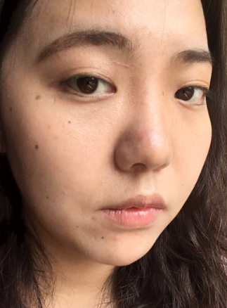 长效玻尿酸