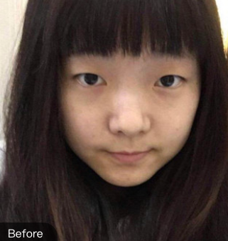 双眼皮手术