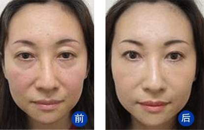 去眼袋手术
