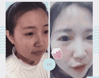 超皮秒祛斑