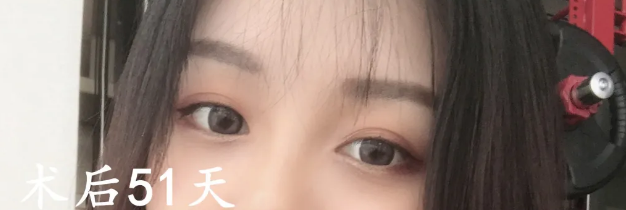 双眼皮手术
