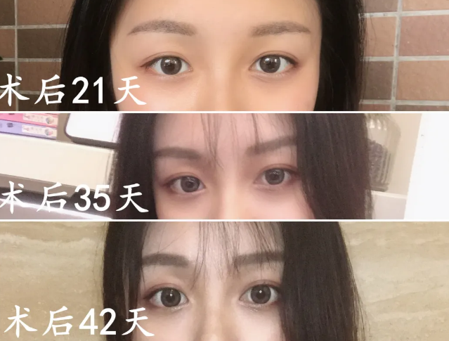 双眼皮手术