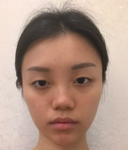 双眼皮手术