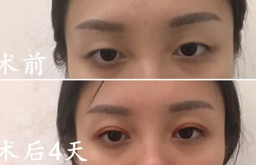 双眼皮手术