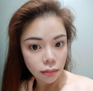 长效玻尿酸