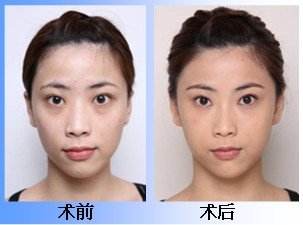 去眼袋手术