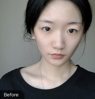 双眼皮手术
