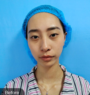 双眼皮手术