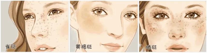 超皮秒祛斑