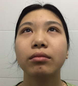 长效玻尿酸