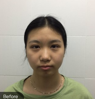 长效玻尿酸