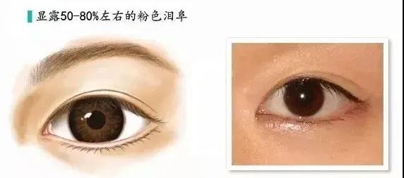 双眼皮手术
