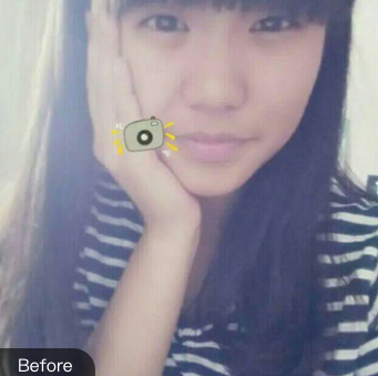 双眼皮手术