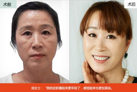 面部提升术