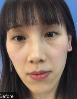 去眼袋手术