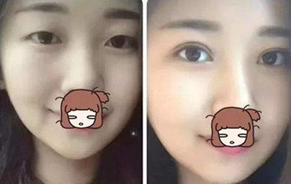 双眼皮手术