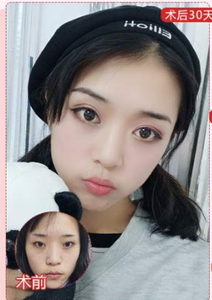 双眼皮手术