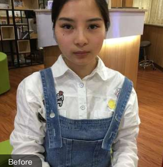 长效玻尿酸