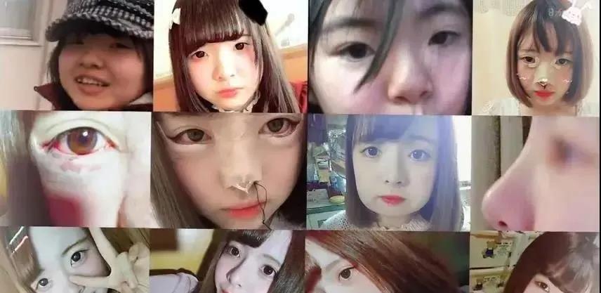 双眼皮手术