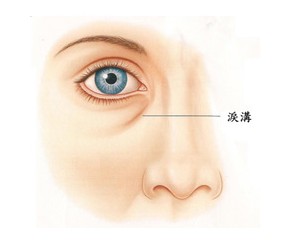长效玻尿酸